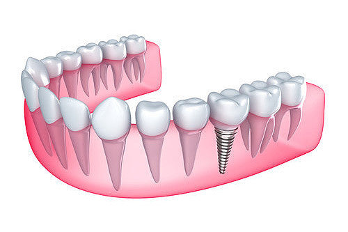 Dental Implants