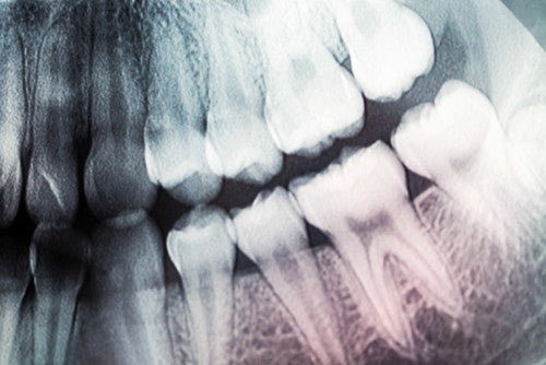 $59 X-Ray and Dental Cleaning