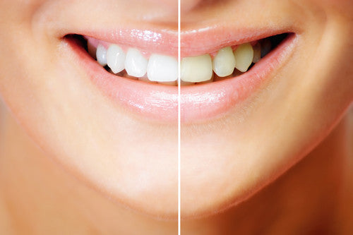 $129 for In-Office Zoom! Teeth Whitening